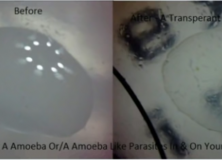 Eczema is Morgellons Disease & Morgellons Disease Is A Fungi (Aspergillus Fumigatus)